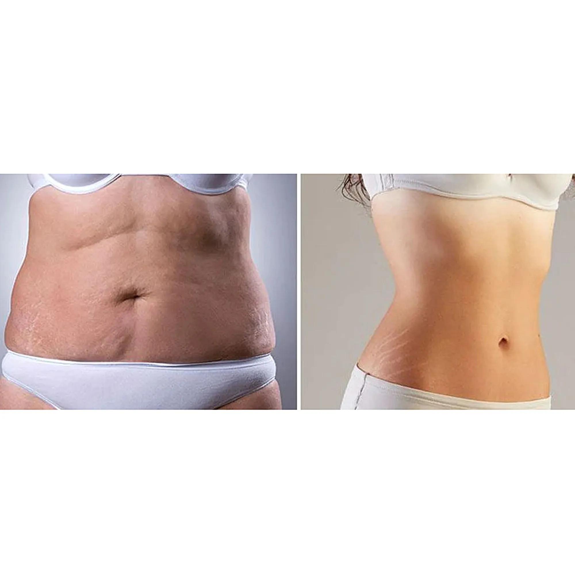 Cellulite Waist Band